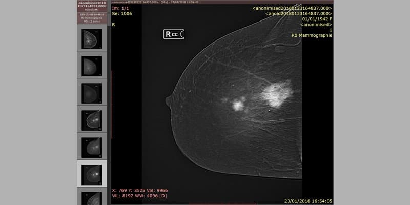 Kontrastförstärkt mammografi.jpg