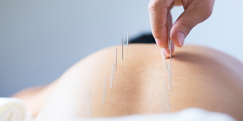 Akupunkturnålar på en rygg.